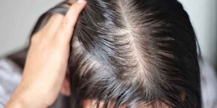 Cách cải thiện mái tóc thưa mỏng