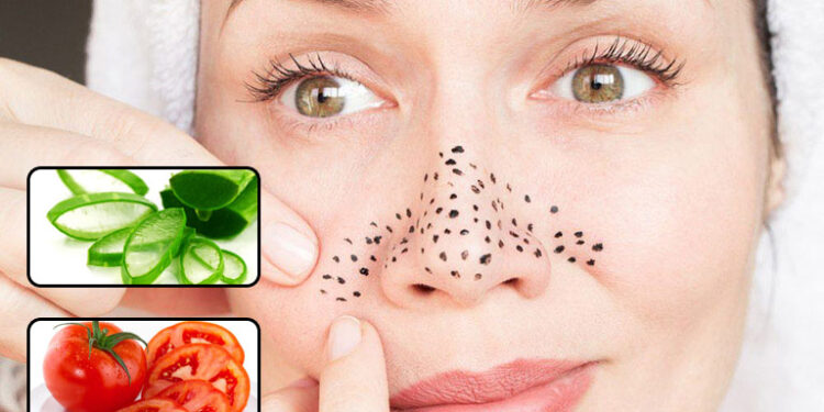 Những cách trị mụn đầu đen tại nhà